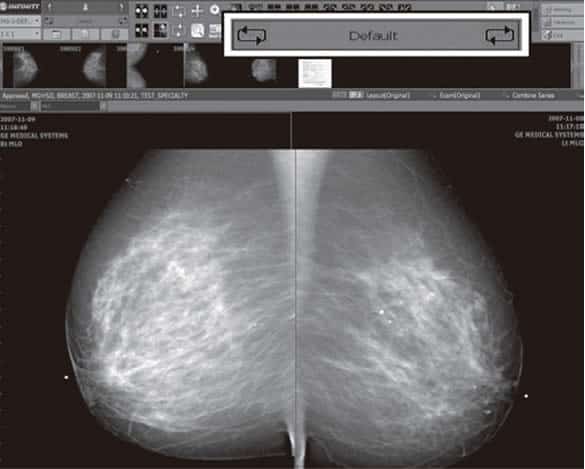 Infinitt Mammography