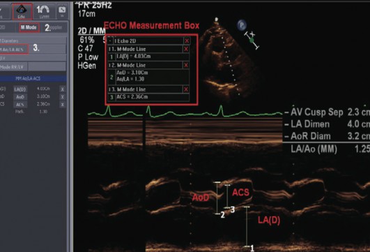 Echocardiography1